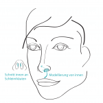 Grafik Nasenkorrektur geschlossener Zugang, Mund-Kiefer-Gesichtschirurgie (MKG) in München, Dr. Dannemann