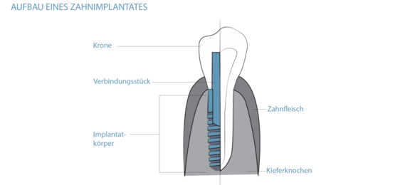 Grafik Aufbau Zahnimplantat, Mund-Kiefer-Gesichtschirurgie (MKG) in München, Dr. Dannemann