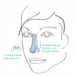 Grafik Nasenkorrektur offener Zugang, Mund-Kiefer-Gesichtschirurgie (MKG) in München, Dr. Dannemann