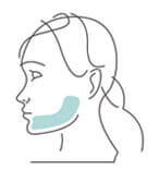 Grafik Unterkieferverlagerung, Mund-Kiefer-Gesichtschirurgie (MKG) in München, Dr. Dannemann