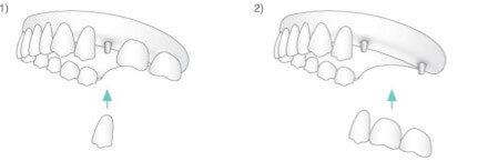Grafik Zahnimplantate, Mund-Kiefer-Gesichtschirurgie (MKG) in München, Dr. Dannemann